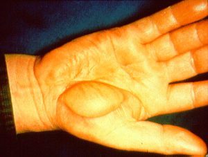 Electrical burns may show erythema and bullae from the heat of arcing current or may be non-descript with severe internal damage between the points of contact and exit of the electrical current.