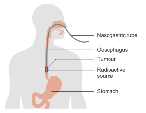 Diagram showing internal radiotherapy for cancer of the oesophagus.