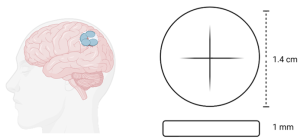 Gliadel wafers are surgically inserted into the resection cavity post-surgical removal of the tumor to release chemotherapy drug. Gliadel wafers are 1.4 cm in diameter and 1 mm in thickness and are used to treat Glioblastomas.