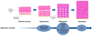 Figure 1. Stages of morphological cellular adaptations and molecular changes leading to lung cancer. Representative illustration highlighting morphological alterations of the epithelial cells during the gradual transition towards lung cancer and key molecular alterations contributing to this process.