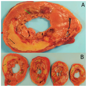 After a myocardial infarction, 2 lesions involving the myocardium and the papillary muscles are seen. A and B. Green arrows point to dark mottling, and the black arrows point to a yellow, softened lesion with red-tan borders; these correspond to a myocardial infarction in between 12 to 24 hours and10 to 14 days, respectively. Early coagulative necrosis appears as dark mottling due to regions of hyperemia, edema, and hemorrhage and inflammation. Ischemia leads to cells dying and cellular proteins denaturing in dying and dead cells. The nuclei of dying cells disintegrates and more proteins become denatured giving rise to later signs of coagulative necrosis - a yellow cheese-like mass. The area is infiltrated by neutrophils and macrophages that phagocytose necrotic cells.