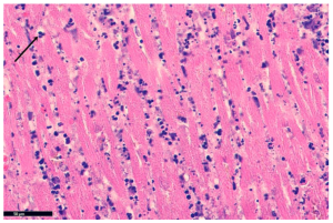 Coagulative necrosis of the cardiomyocytes with absent nuclei and an interstitial neutrophilic infiltrate (black arrow) within 12-24 hours of infarction.