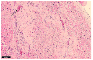 Well-formed granulation tissue with collagen deposition and neovascularization (black arrow). Granulation tissue consists of newly formed blood vessels (angiogenesis), specialized fibroblasts, macrophages and other white blood cells. As collagen deposition by specialized fibroblasts increases and cellular debris is phagocytosed a dense collagenous scar will develop. Fibrosis, or scarring, begins in around 2 weeks, and eventually, complete scar formation occurs in 2 months.