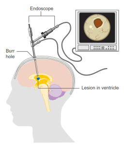 Neuroendoscopy, also called keyhole brain surgery involves creating a small burr hole in the skull to insert an endoscope that has both a camera as well as tiny forceps at the end of it. This can be used to remove a tumor in the ventricles of the brain or remove fluid in the brain (hydrocephalus).