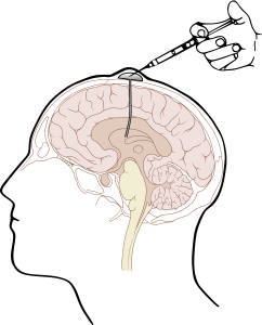 An Ommaya reservoir (small plastic dome under the skin of the scalp) is used to deliver chemotherapy drug into the ventricles (CSF containing spaces) of the brain. This bypasses the blood brain barrier, meaning smaller doses of chemotherapy are used.