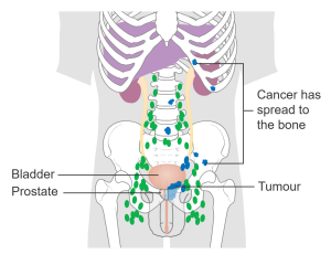 Prostate Cancer that has spread to the Bone