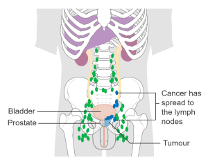 Prostate Cancer that has spread to the Lymph Nodes