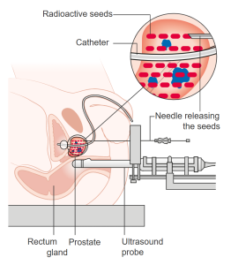 Permanent Seed Brachytherapy is a means by which radioactive seeds are implanted into a localized prostate cancer. A urinary catheter is used to drain the bladder and show the position of the urethra within the prostate gland on ultrasound. The ultrasound probe placed in the rectum gives a clear picture of the prostate and helps guides the insertion of 60-80 small radioactive seeds into the prostate gland.