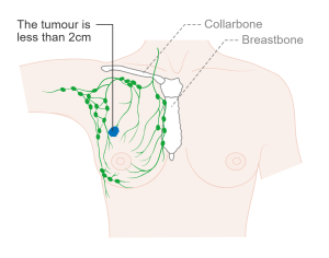 Stage 1A Breast Cancer. In the TNM staging system, stage 1A breast cancer is the same as T1 N0 M0. This indicates that the cancer is small (e.g., 2cm or smaller) and cancer which hasn't spread to the lymph nodes or elsewhere in the body.