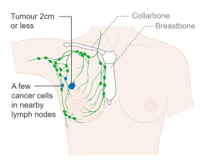 Stage 1B means that a few breast cancer cells are found in the lymph nodes close to the breast and that tumor is 0-2cm. Stage 1B therefore presents as either: T0 N1mi M0 or T1 N1mi M0