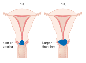 Stage 1B Cervical Cancer