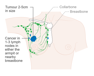 Stage 2 Breast Cancer can present in various ways, with a tumor ranging in size 2-5cm, and possible involvement of lymph nodes in the armpit and/or nearby breastbone (sternum).