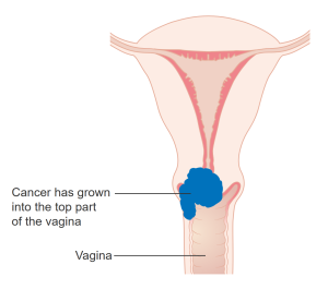 Stage 2A Cervical Cancer