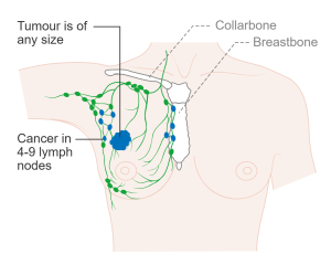 Stage 3 Breast Cancer can take many forms with increases in tumor size, and/or increases in the number and/or spread of lymph node involvement (e.g., in armpit, near breastbone, and/or under collarbone).