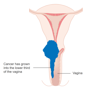 Stage 3A Cervical Cancer