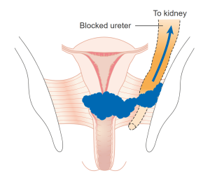 Stage 3B Cervical Cancer. Stage 3 means the cancer has spread from the cervix into the structures around it or into the lymph nodes in the pelvis or abdomen. In this case it has blocked one of the ureters. Treatment is usually chemoradiotherapy.