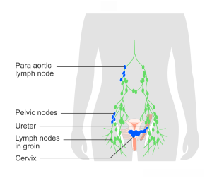 Stage 3 Cervical Cancer means the cancer has spread from the cervix into the structures around it or into the lymph nodes in the pelvis or abdomen. Treatment is usually chemoradiotherapy.