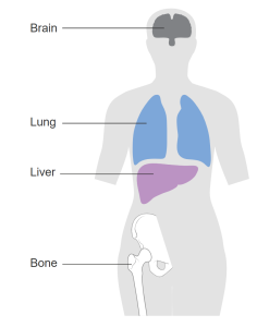 In Stage 4 Breast Cancer, the tumor can be any size, lymph nodes may or may not contain cancer cells, and the cancer has metastasized to other parts of the body such as the bones, lungs, liver, or brain.