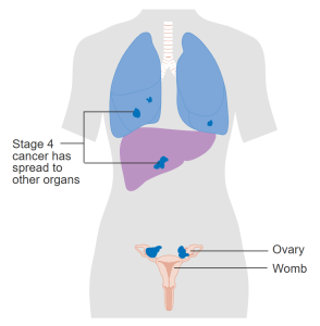 Stage 4 Ovarian Cancer - Spread to Other Organs
