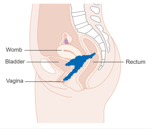 Stage 4A Cervical Cancer is depicted by spread to nearby organs such as bladder or rectum.