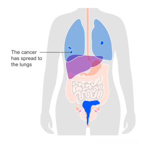 Stage 4B Cervical Cancer means the cancer has spread to organs that are further away (e.g., lungs).