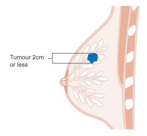 Stage T1 Breast Cancer