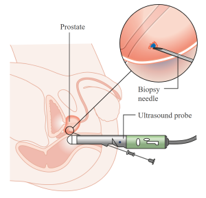 Transrectal Ultrasound Scan (TRUS) and biopsy for prostate cancer involves insertion of an ultrasound probe to guide a fine needle into the prostate gland to collect a biopsy sample.