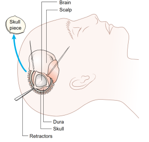 A craniotomy can allow for surgical removal of a brain tumor or is sometimes used to remove hematomas (blood clots), fix vascular malformations, and decrease intracranial pressure.