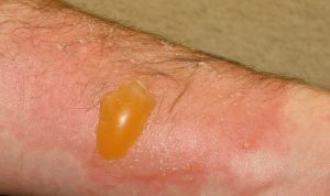 2nd Degree Burn Blister
