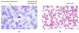 Blood smears showing two diseases of the blood. (a) Malaria is an infectious, zoonotic disease caused by the protozoan pathogen Plasmodium falciparum (shown here) and several other species of the genus Plasmodium. It is transmitted by mosquitoes to humans. (b) Sickle cell disease is a noninfectious genetic disorder that results in abnormally shaped red blood cells, which can stick together and obstruct the flow of blood through the circulatory system. It is not caused by a pathogen, but rather a genetic mutation.