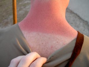 1st Degree Burn - Sunburn
