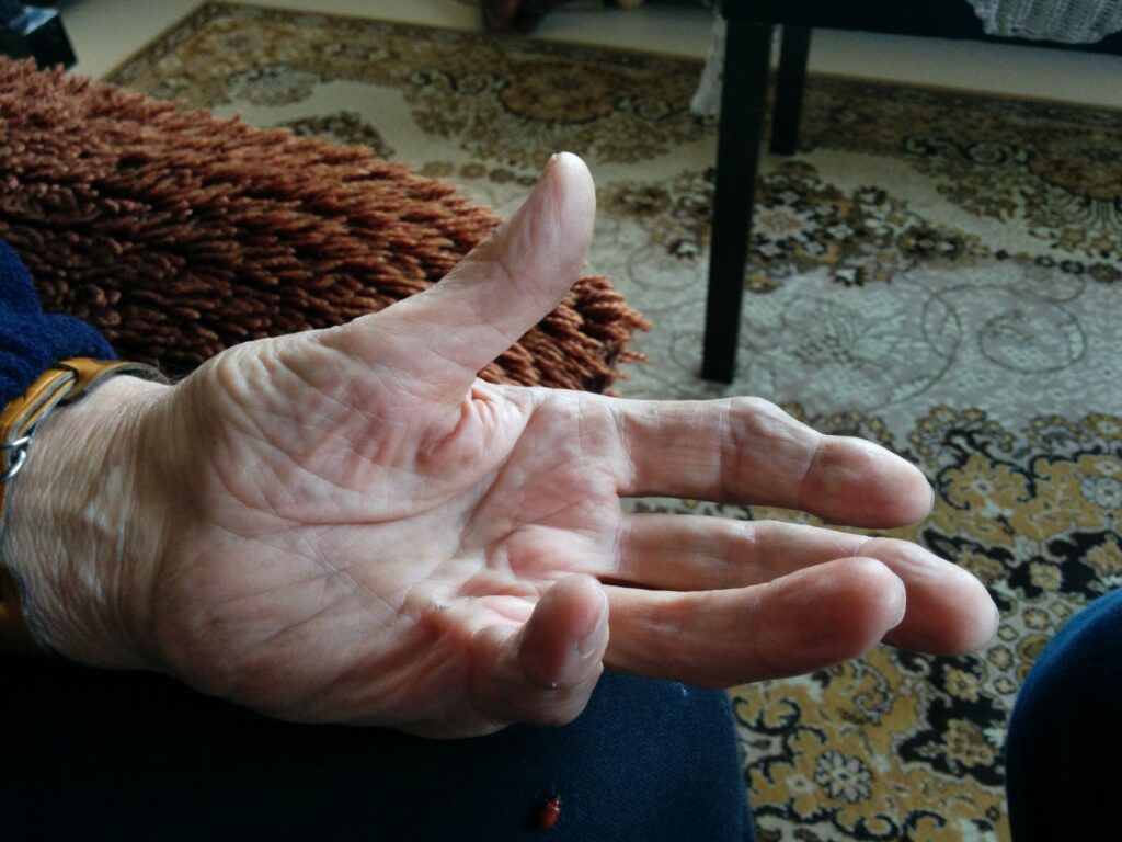 Dupuytren´s contracture