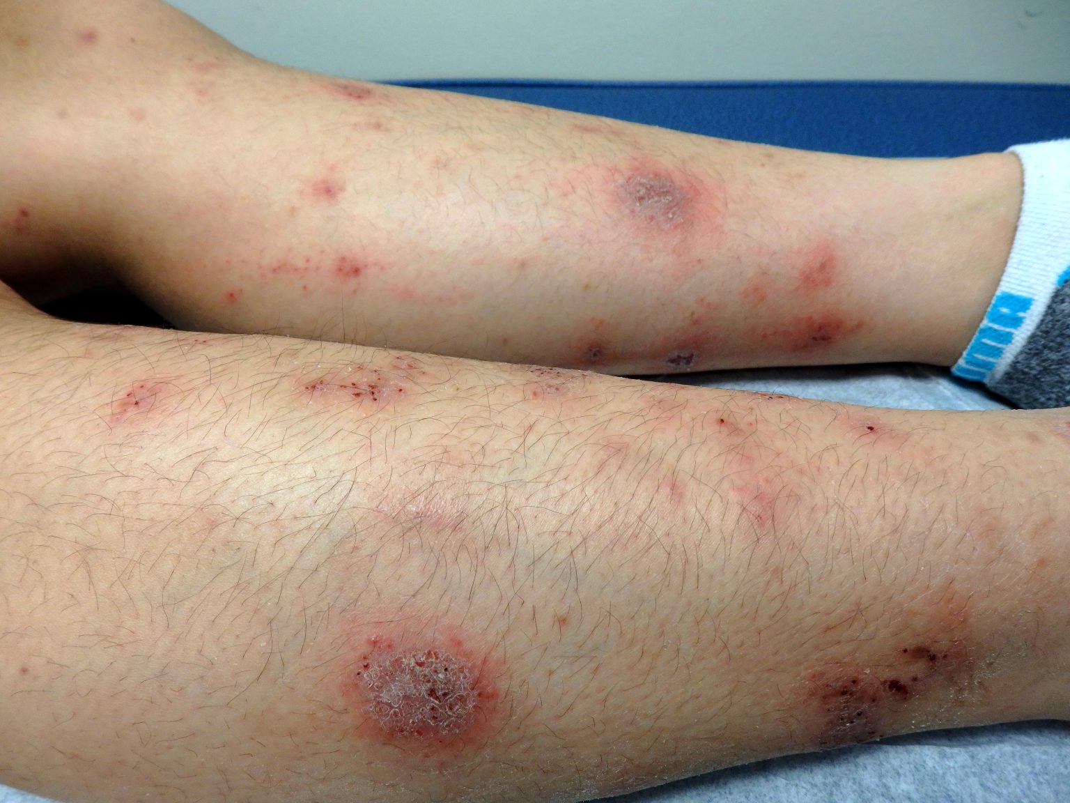 Nummular Eczema/ Nummular Dermatitis – Pediatric Dermatology