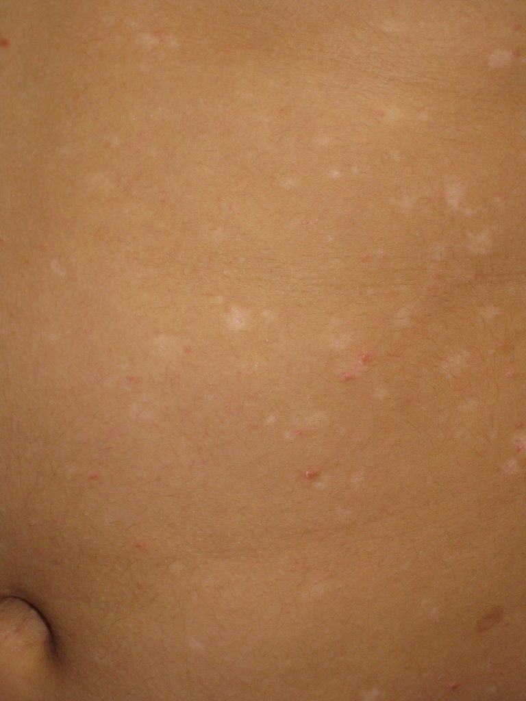 Pityriasis Lichenoides (PLC/PLEVA) – Pediatric Dermatology