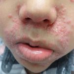 Periorificial Dermatitis – Pediatric Dermatology