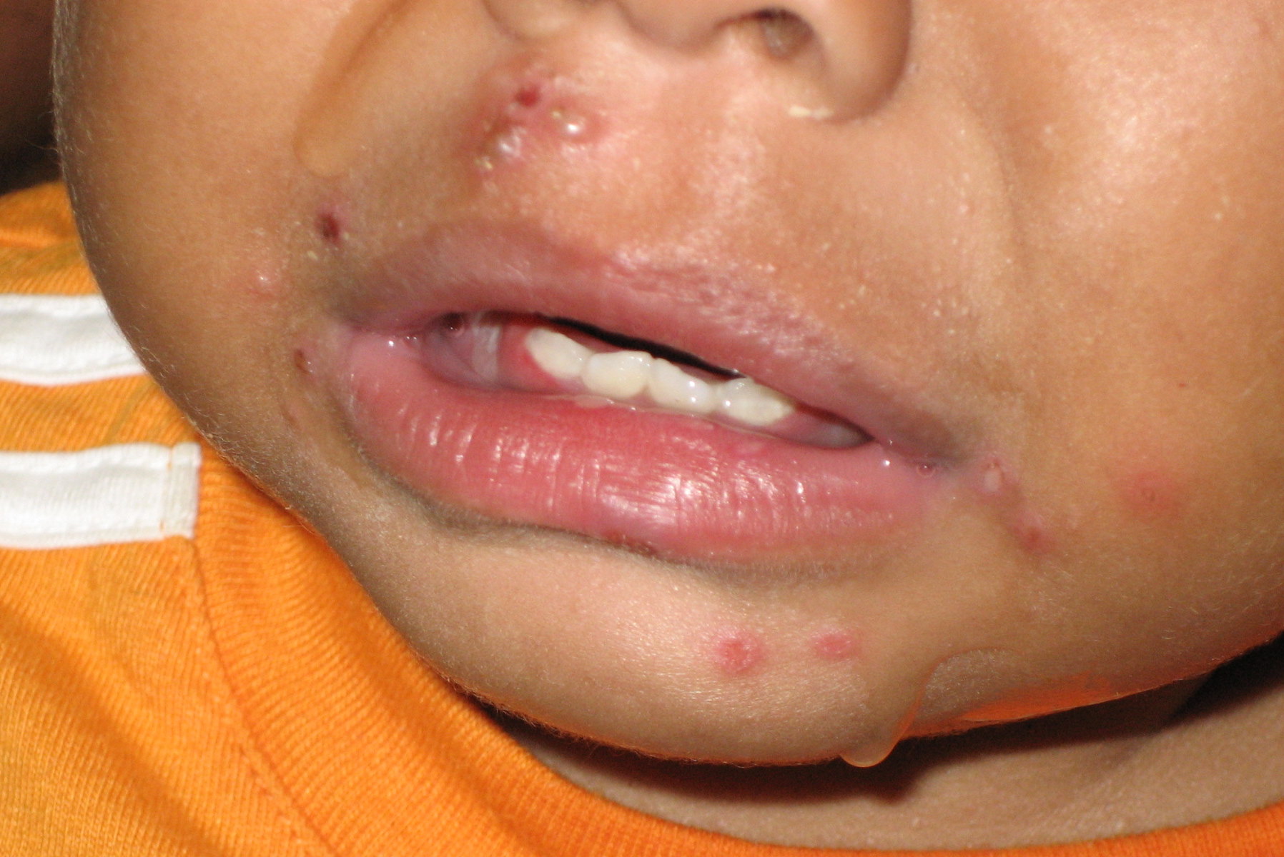 Viral Infections Herpes Simplex Virus 1 and 2 Pediatric Dermatology