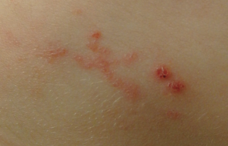 Vascular Malformations: Venous, Arteriovenous and Lymphatic ...