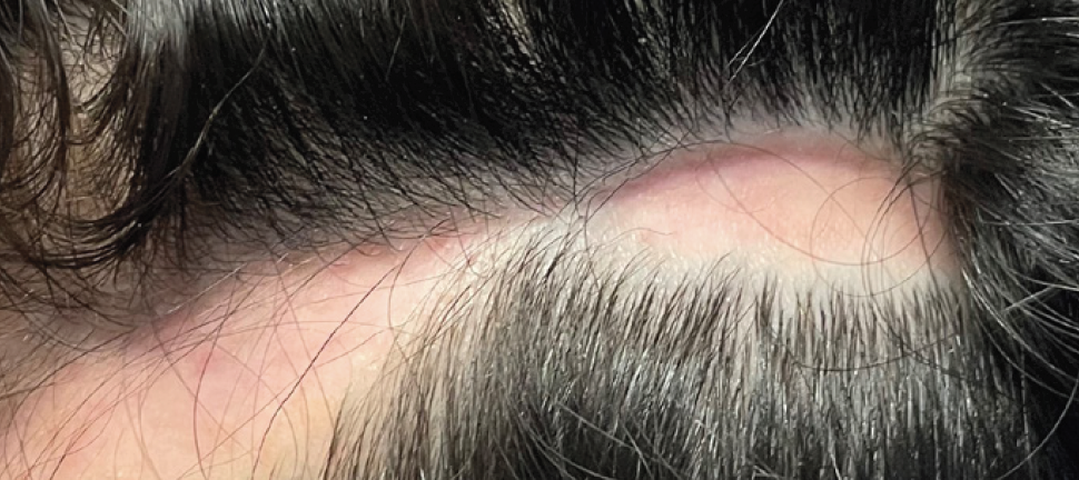 Localized Scarring Alopecia: Discoid Lupus – Pediatric Dermatology