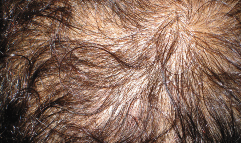 Diffuse Non-Scarring Alopecia – Pediatric Dermatology