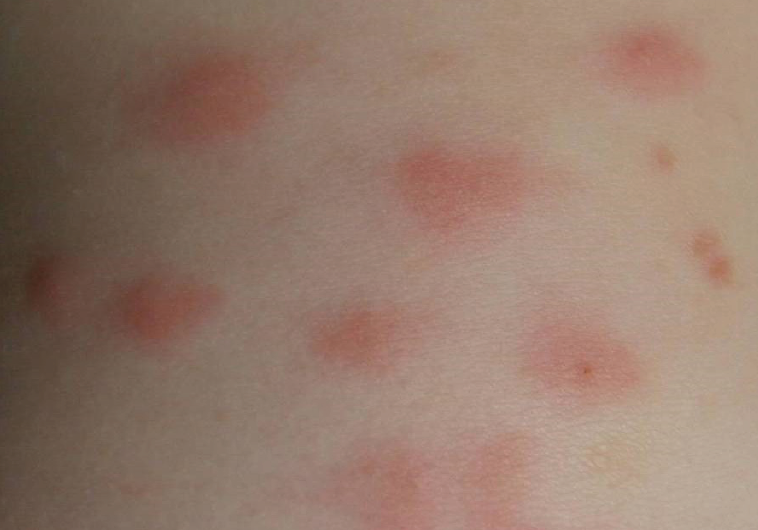 bites-and-stings-papular-urticaria-pediatric-dermatology