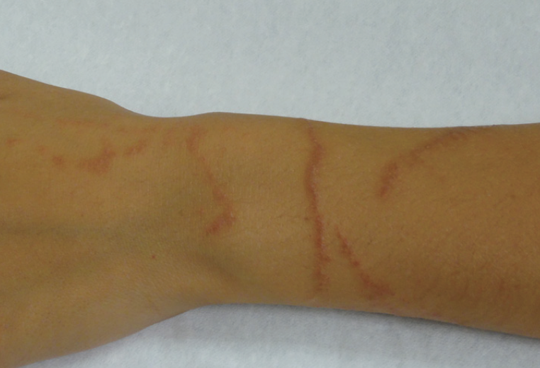 Bites and Stings Seajelly stings Pediatric Dermatology