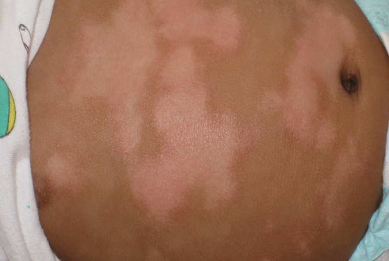 Hyper or Hypopigmented Lesions Pediatric Dermatology