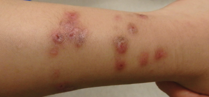 Prurigo Nodularis Pediatric Dermatology 