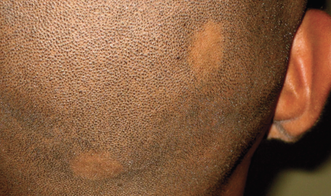 Ch 14: Alopecia areata: Patchy non-scarring hair loss with no associated redness or scale