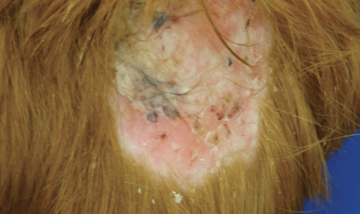 Ch 14: Tinea capitis: Localized alopecia due to severe tinea infection, which regrew entirely after treatment 