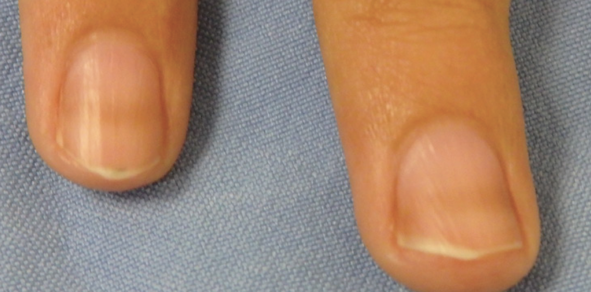 PDF) Lichen striatus in an adult following trauma with central nail plate  involvement and its dermoscopy features | Pablo Coto-Segura - Academia.edu