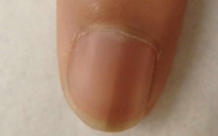 Ch 14: Physiologic melanonychia causing tan band with the nail