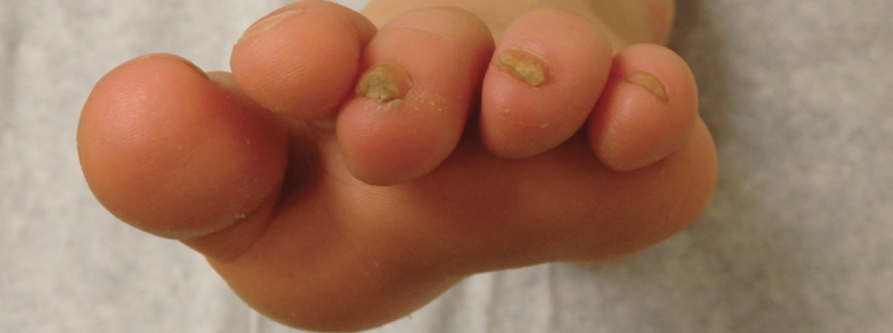 Ch 14: Onychomycosis with thick, crumbly nails