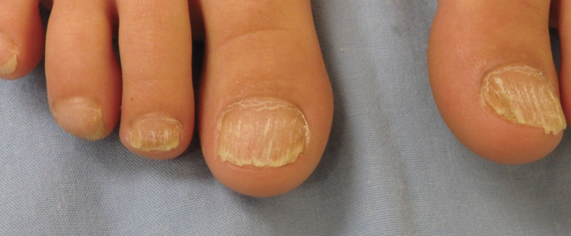 Ch 14: Trachyontchia: Dull lack-luster nails with increased longitudinal ridging