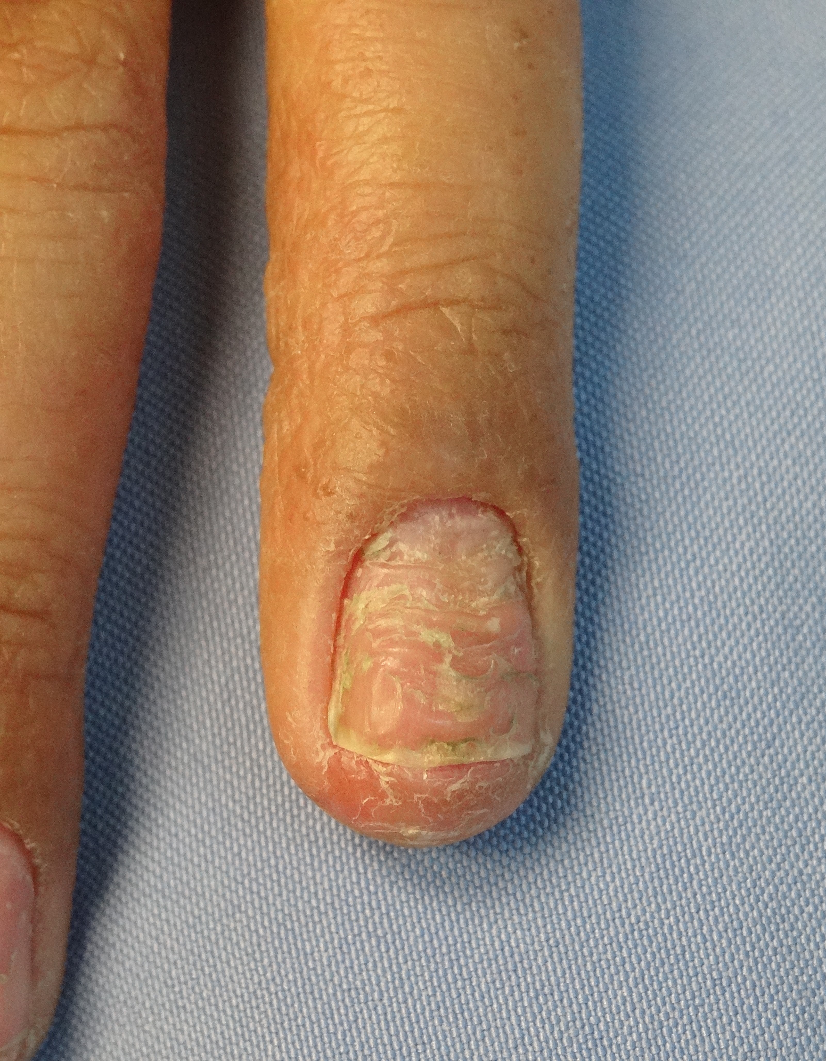 Ch.3: Nail changes due to severe hand eczema